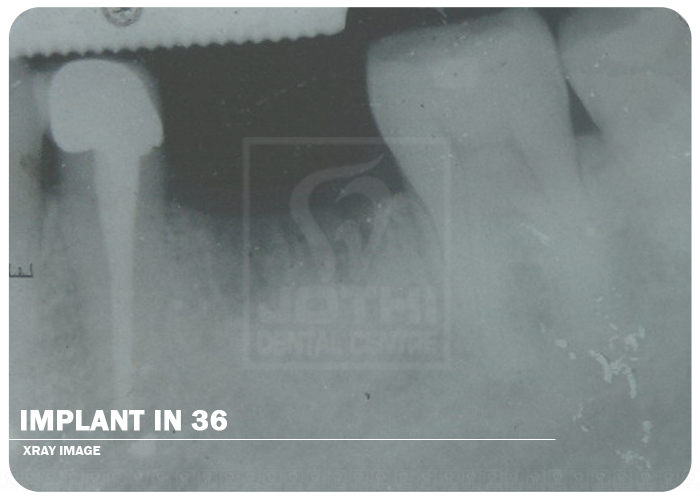 Case Studies, Jothi Dental & Cosmetology Centre, Chennai
