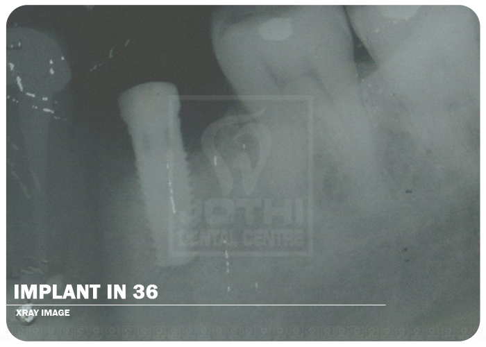 Case Studies, Jothi Dental & Cosmetology Centre, Chennai
