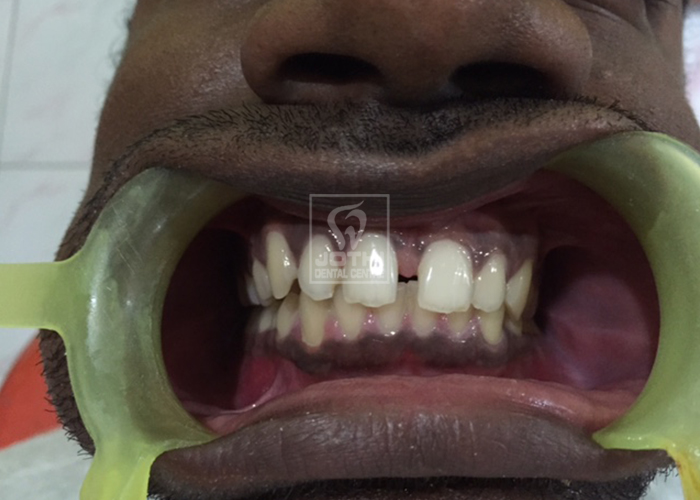 Case Studies, Jothi Dental & Cosmetology Centre, Chennai