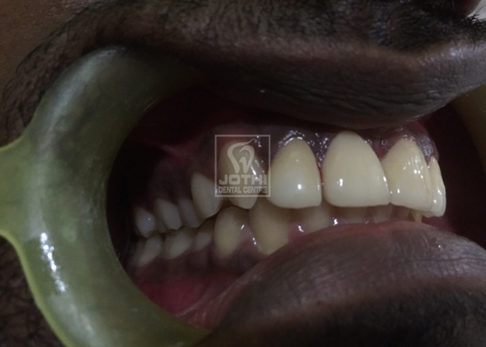 Case Studies, Jothi Dental & Cosmetology Centre, Chennai