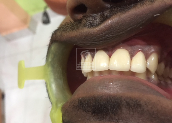 Case Studies, Jothi Dental & Cosmetology Centre, Chennai