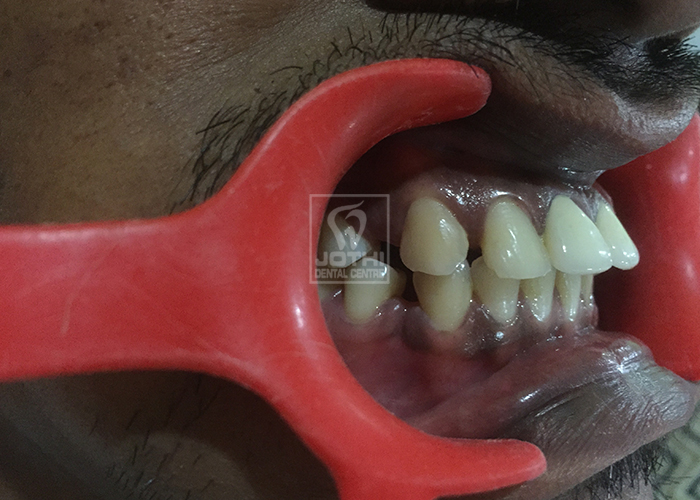Case Studies, Jothi Dental & Cosmetology Centre, Chennai