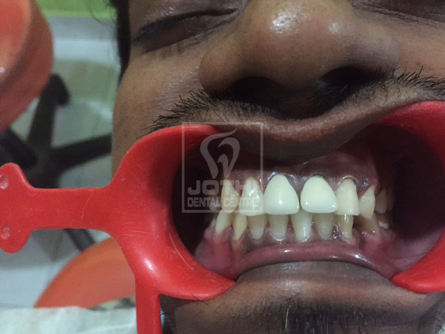 Case Studies, Jothi Dental & Cosmetology Centre, Chennai