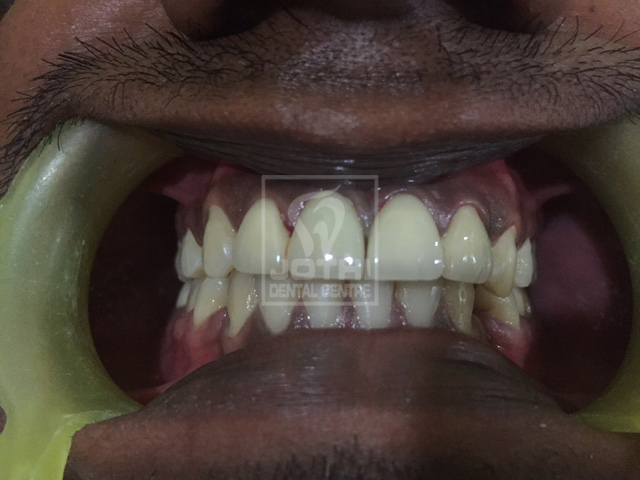 Case Studies, Jothi Dental & Cosmetology Centre, Chennai