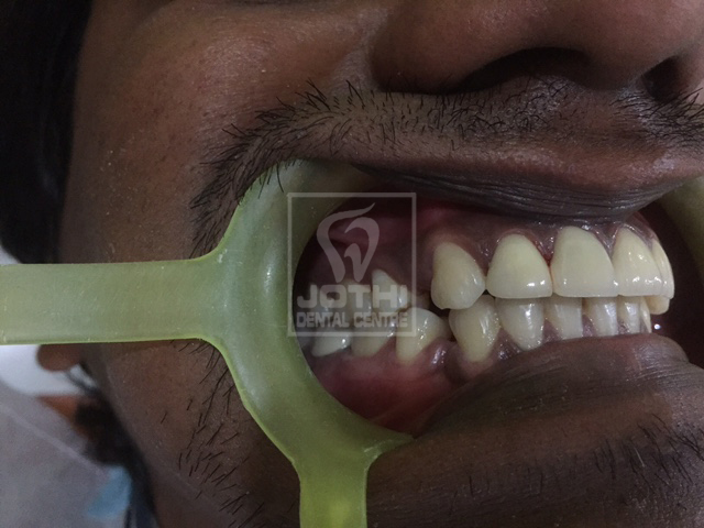 Case Studies, Jothi Dental & Cosmetology Centre, Chennai