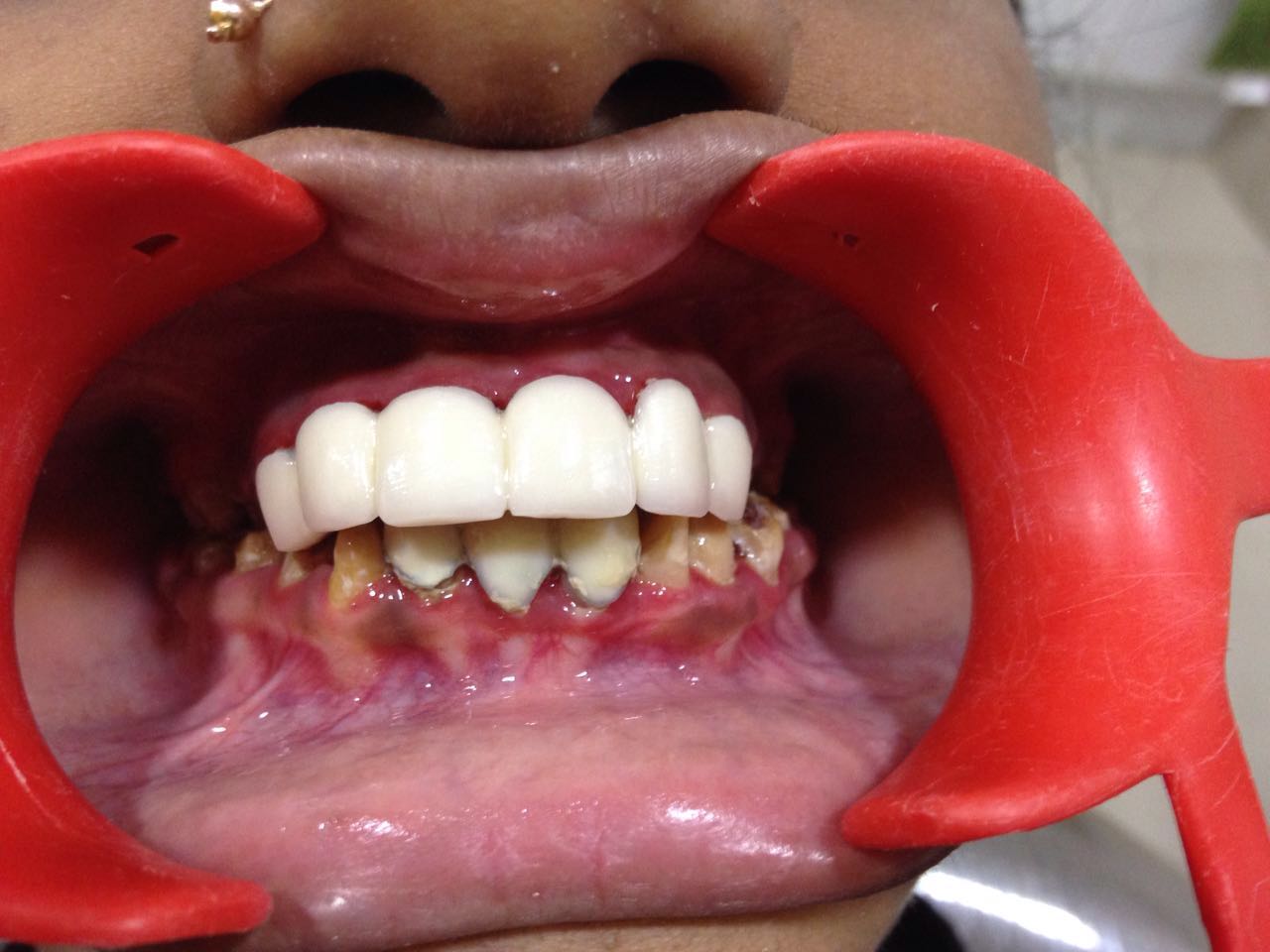 Case Studies, Jothi Dental & Cosmetology Centre, Chennai