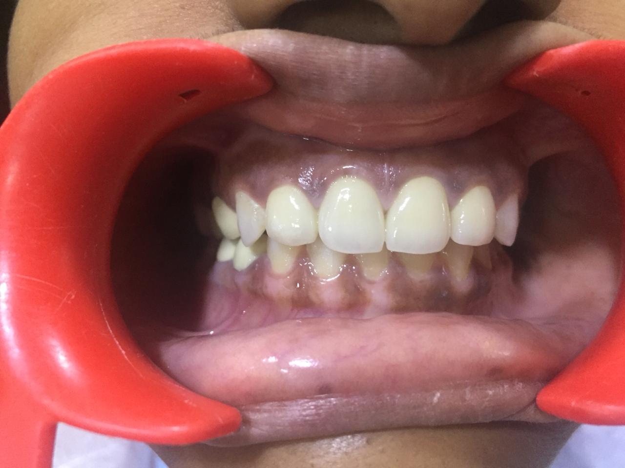 Case Studies, Jothi Dental & Cosmetology Centre, Chennai