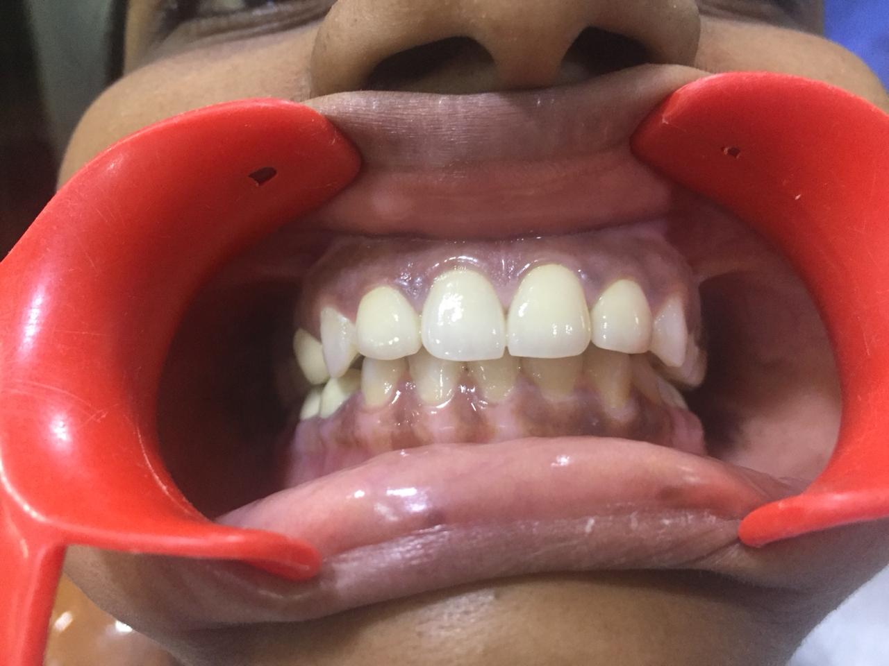 Case Studies, Jothi Dental & Cosmetology Centre, Chennai