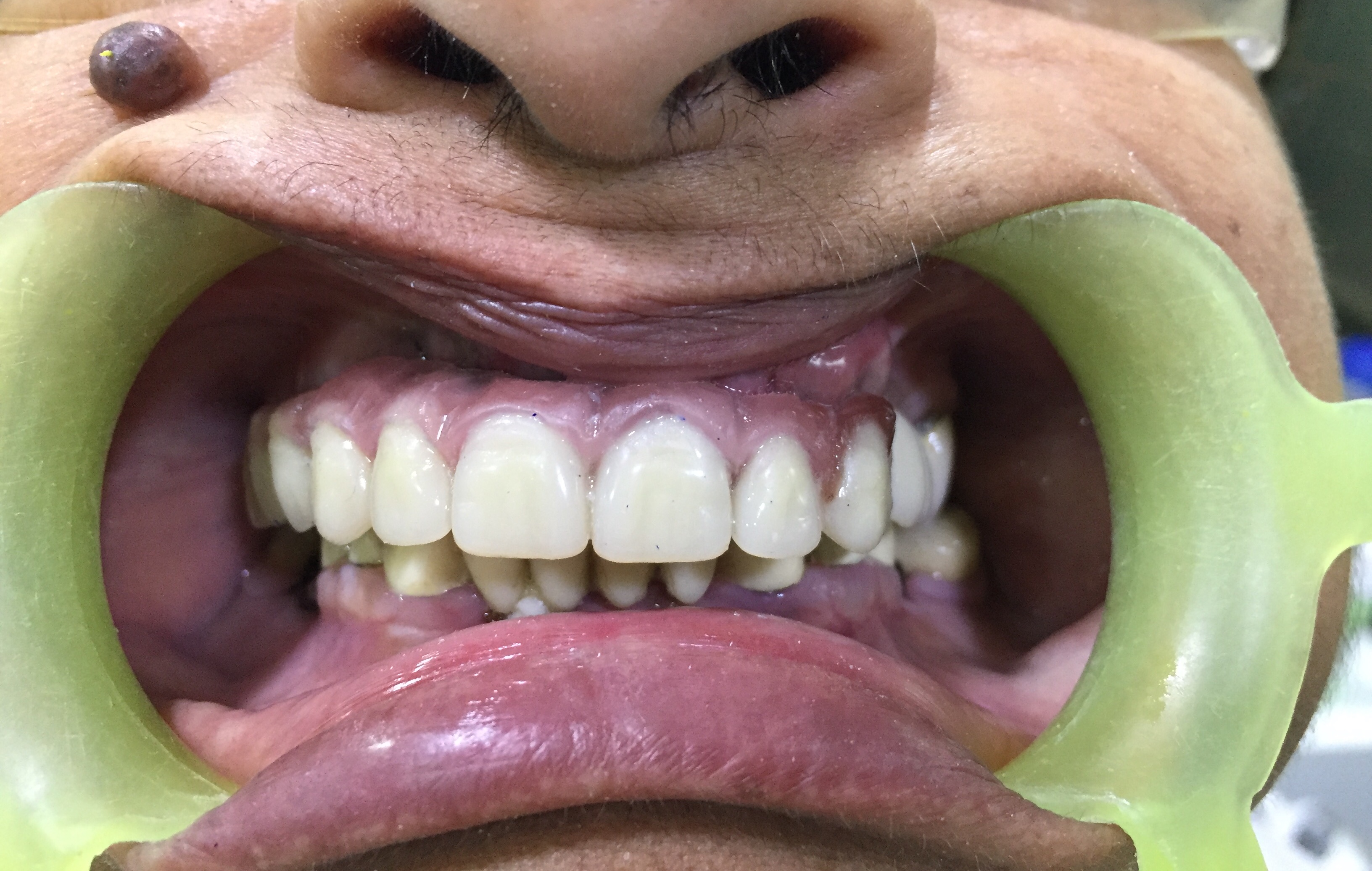 Case Studies, Jothi Dental & Cosmetology Centre, Chennai