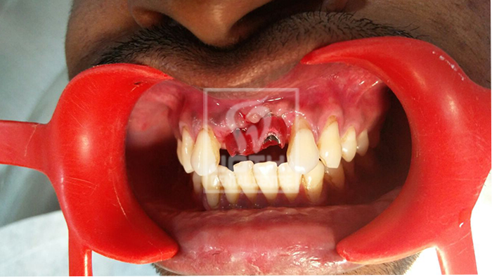 Case Studies, Jothi Dental & Cosmetology Centre, Chennai