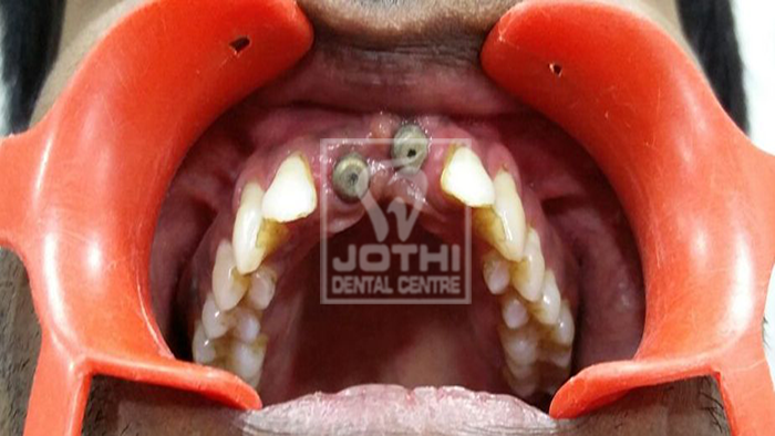 Case Studies, Jothi Dental & Cosmetology Centre, Chennai