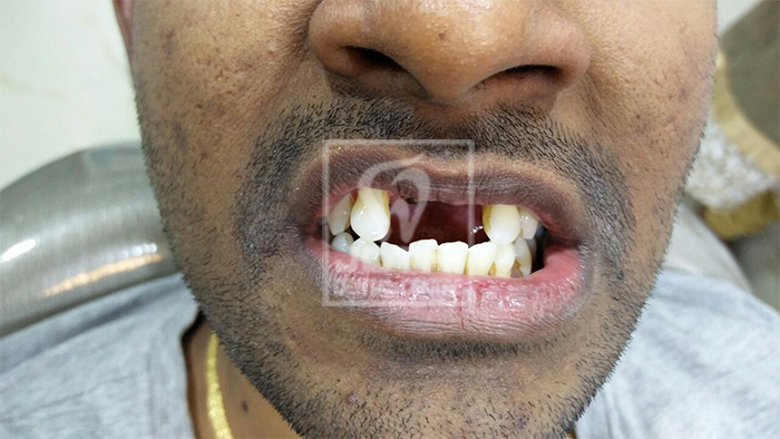 Case Studies, Jothi Dental & Cosmetology Centre, Chennai
