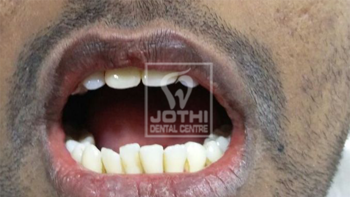 Case Studies, Jothi Dental & Cosmetology Centre, Chennai